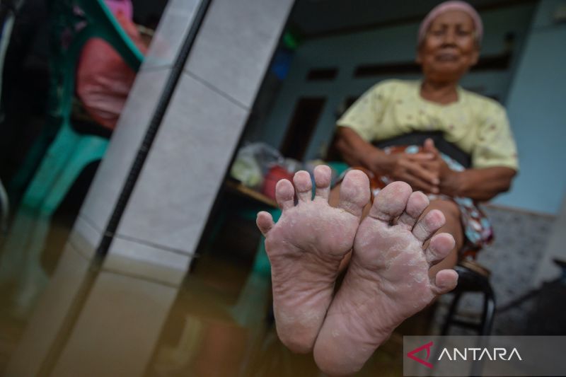 Kaki gatal terus? Kenali 5 penyebab, cara mengatasi dan mencegahnya